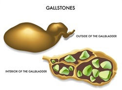 Gallstone Size Chart